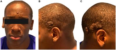 Unusual adult-onset cardiac rhabdomyomas in tuberous sclerosis complex: a case report